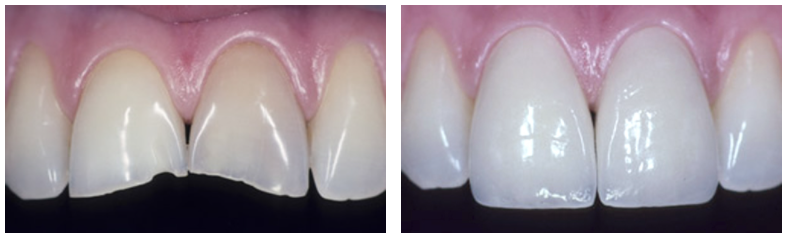 Porcelain veneers before and after in Rochdale