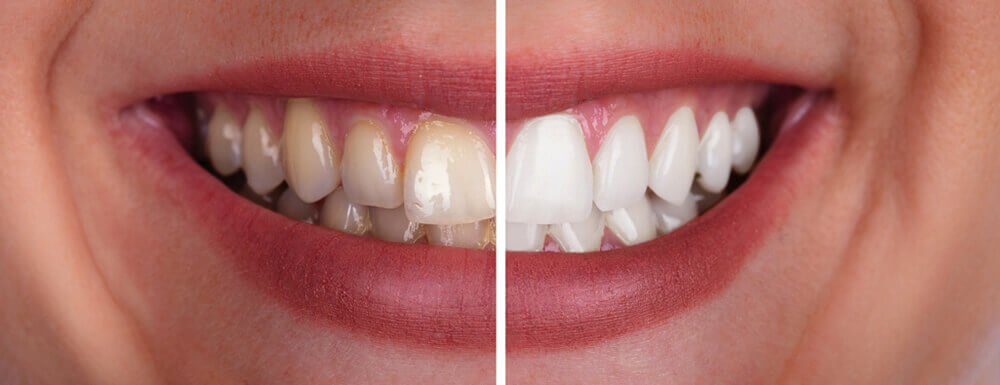 Teeth Whitening example in Rochdale