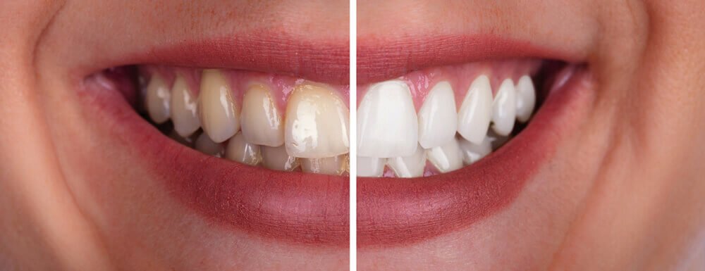 Teeth Whitening